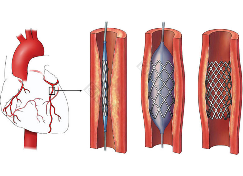 心血管支架示意图