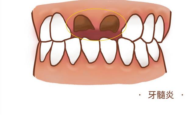牙髓炎口腔疾病