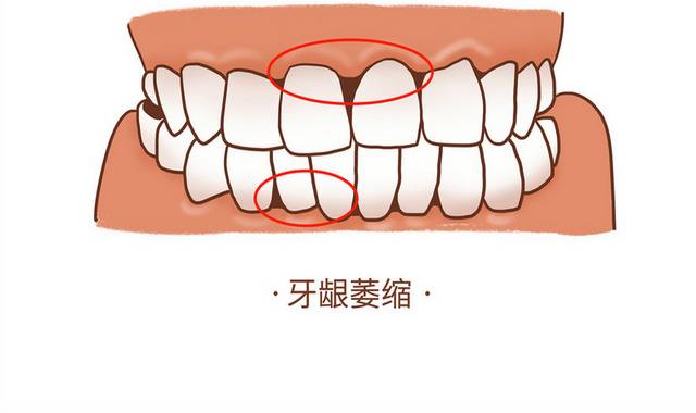 牙龈萎缩