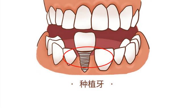 种植牙卡通画