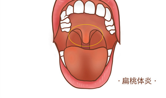 扁桃体口腔疾病